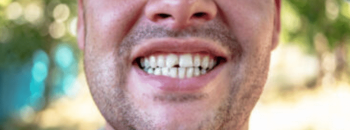 What should I do if I have a Chipped Tooth?