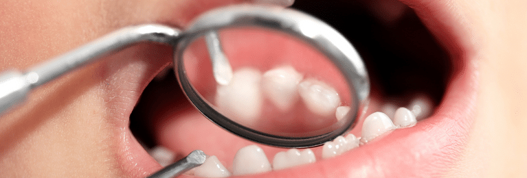 What are the symptoms of cavities?
