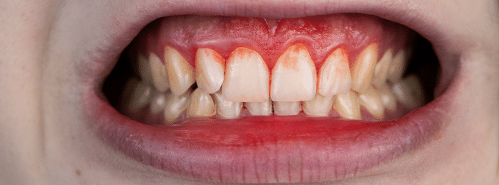 If I get stained teeth, what should I do?