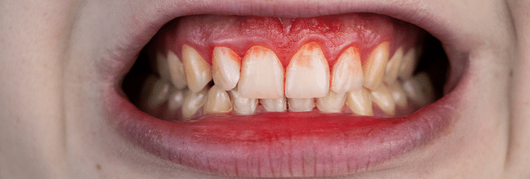 If I get stained teeth, what should I do?